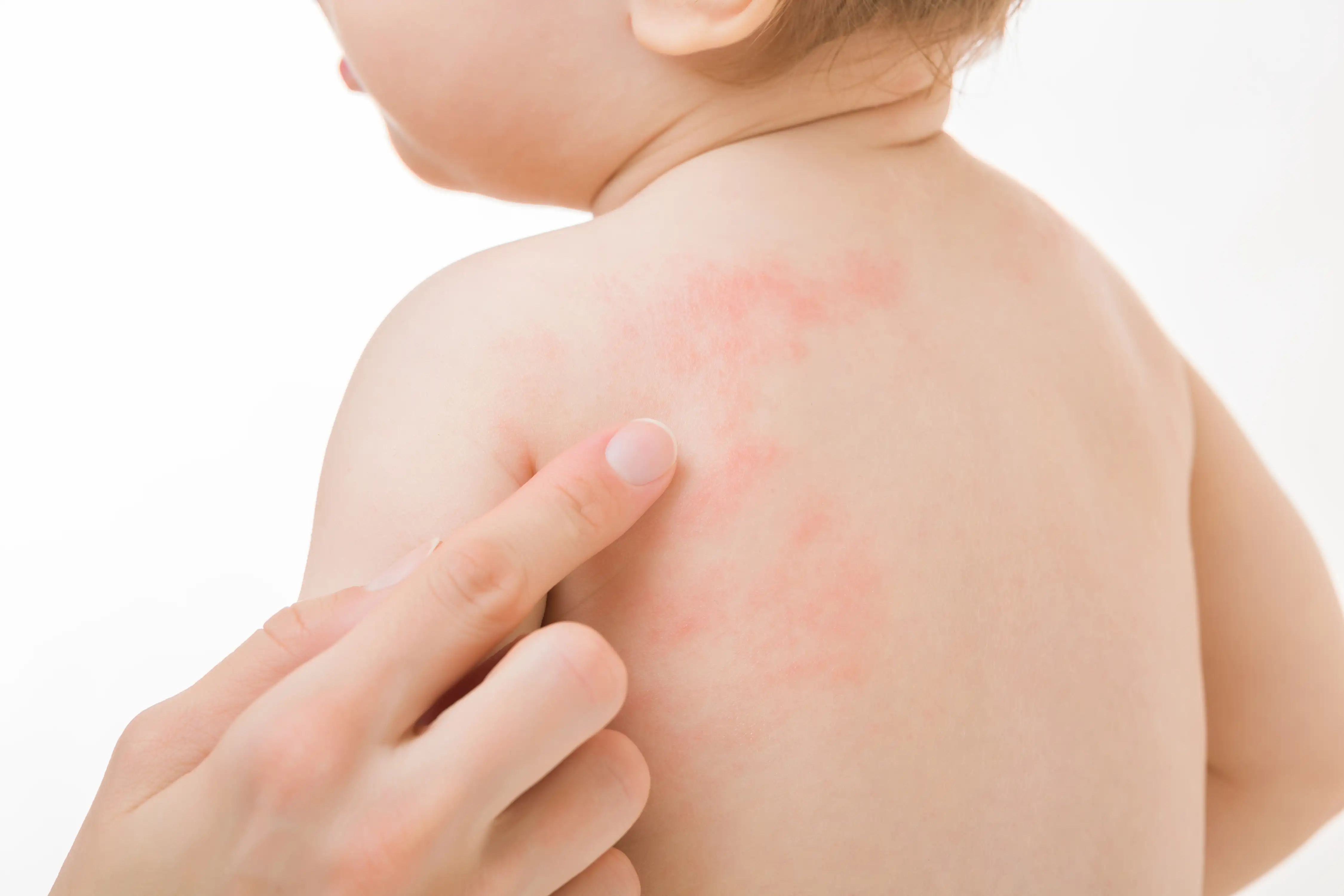 Food allergy