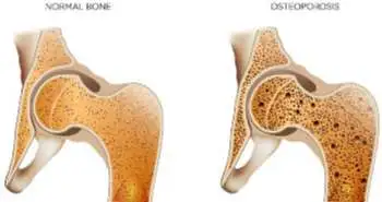 Эффективность и безопасность золедроновой кислоты при остеопорозе у ослабленных пожилых женщин