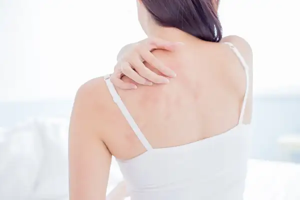 Urticaria