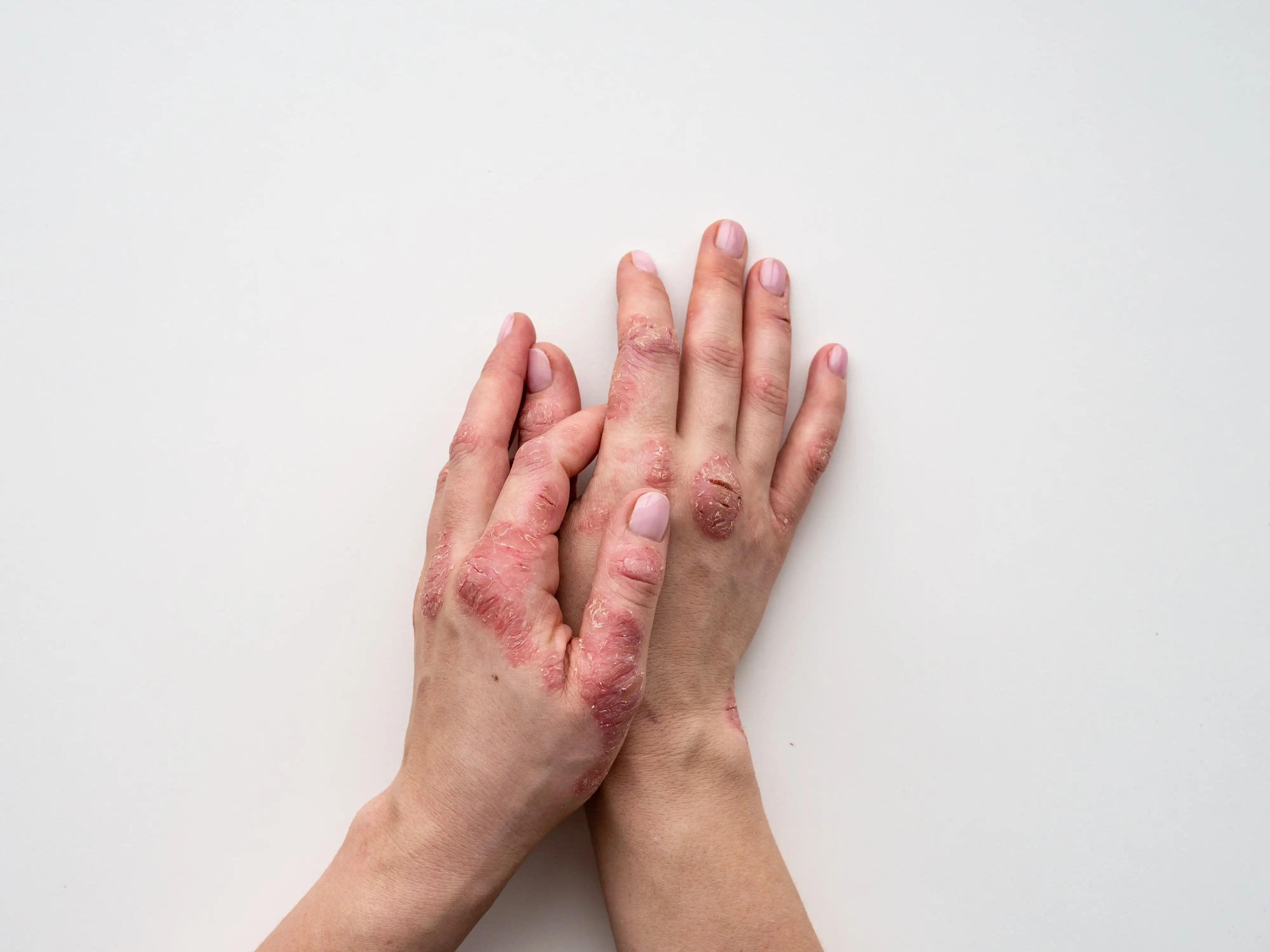 Atopic dermatitis