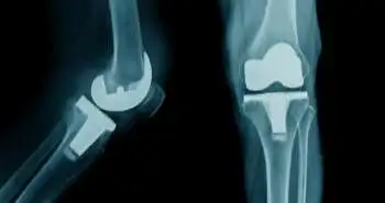 Пациенты с ревматоидным артритом избавятся от боли с помощью протезирования коленного сустава