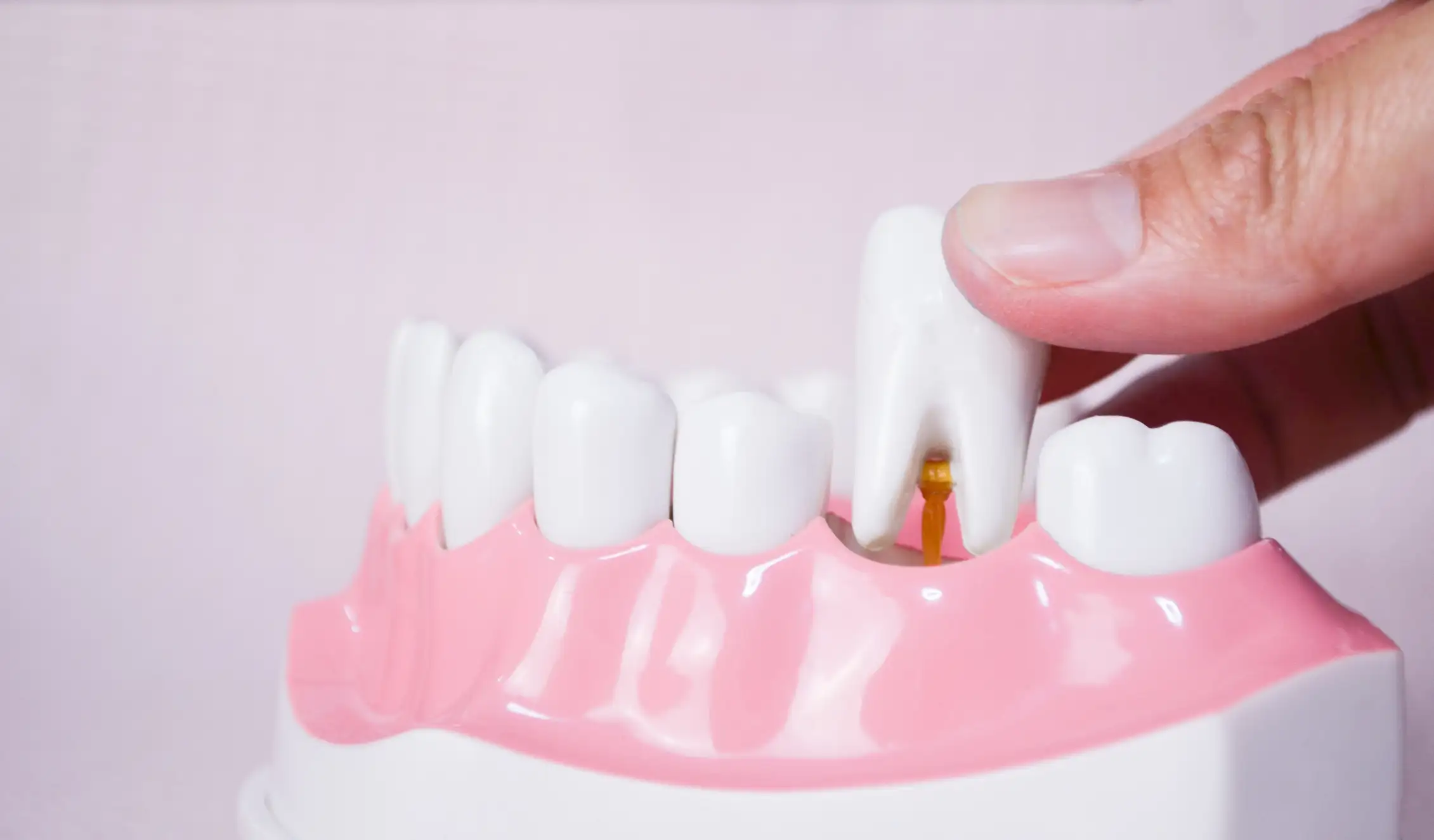 ХБП как фактор риска потери зубов