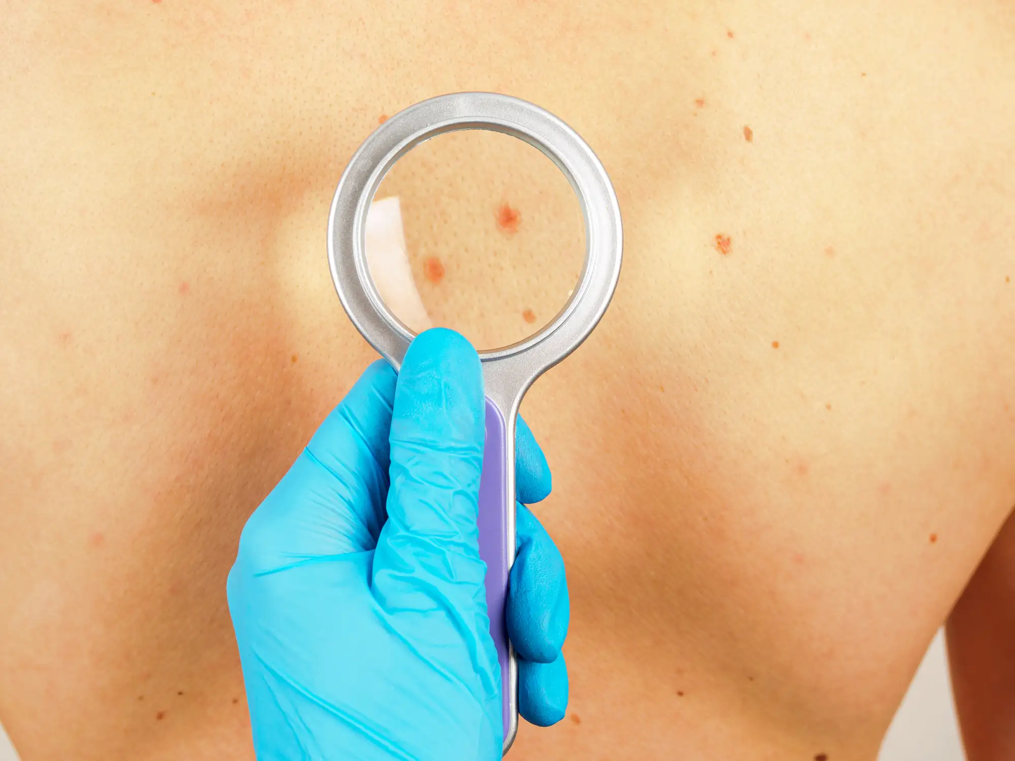 ВПЧ впервые связали с плоскоклеточным раком кожи