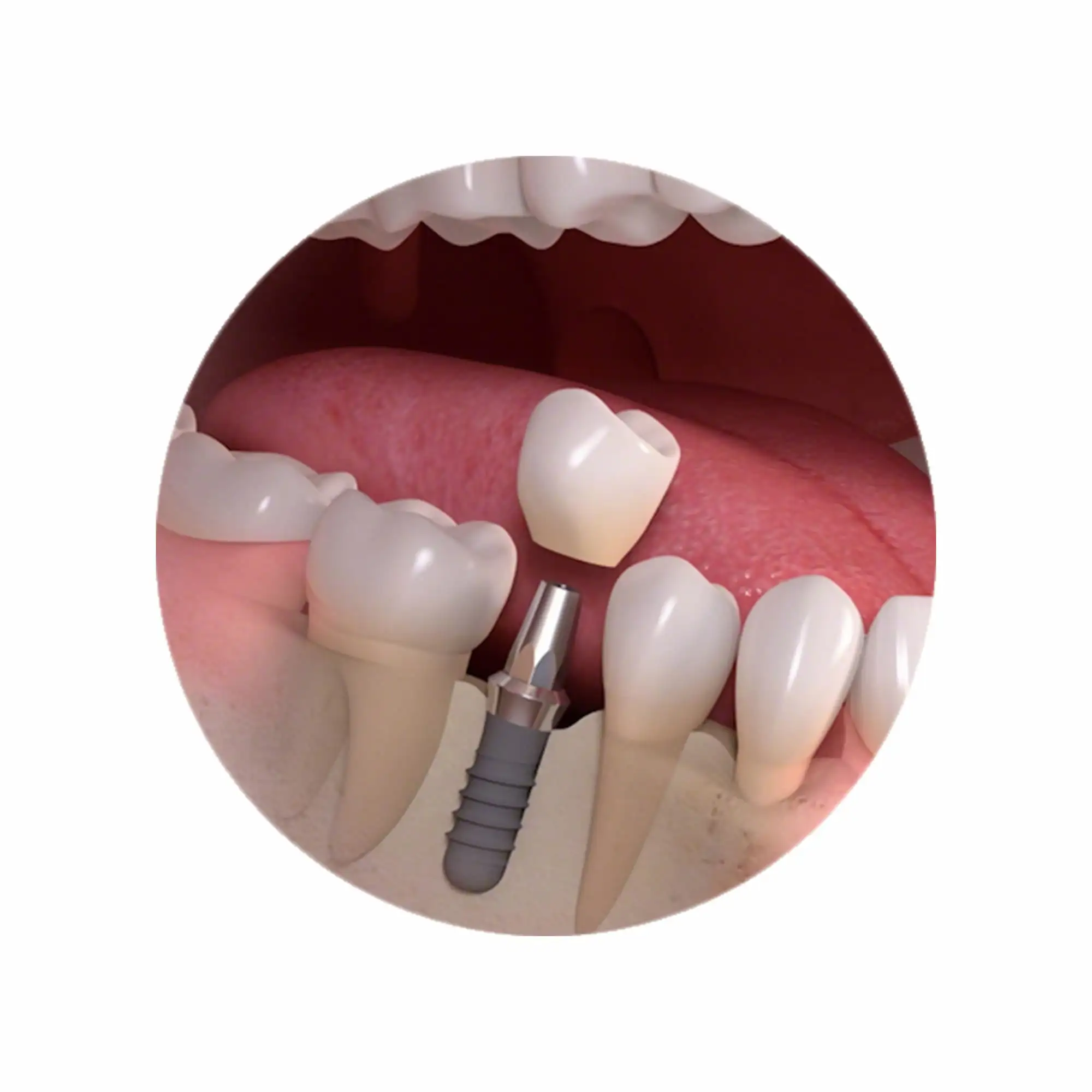 Dental implants