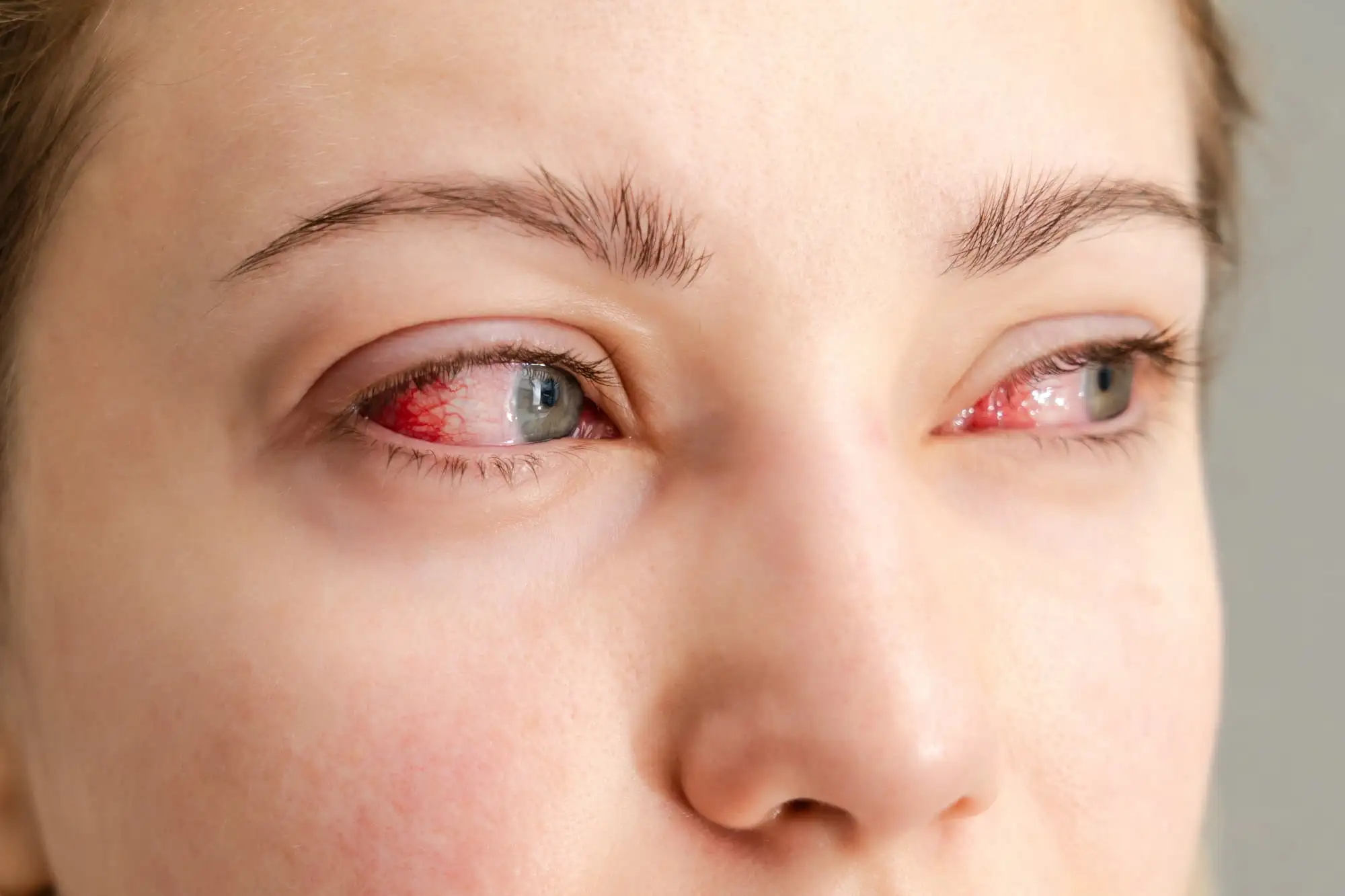 Allergic conjunctivitis