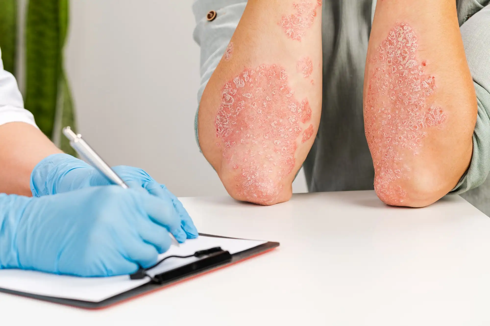 Psoriasis