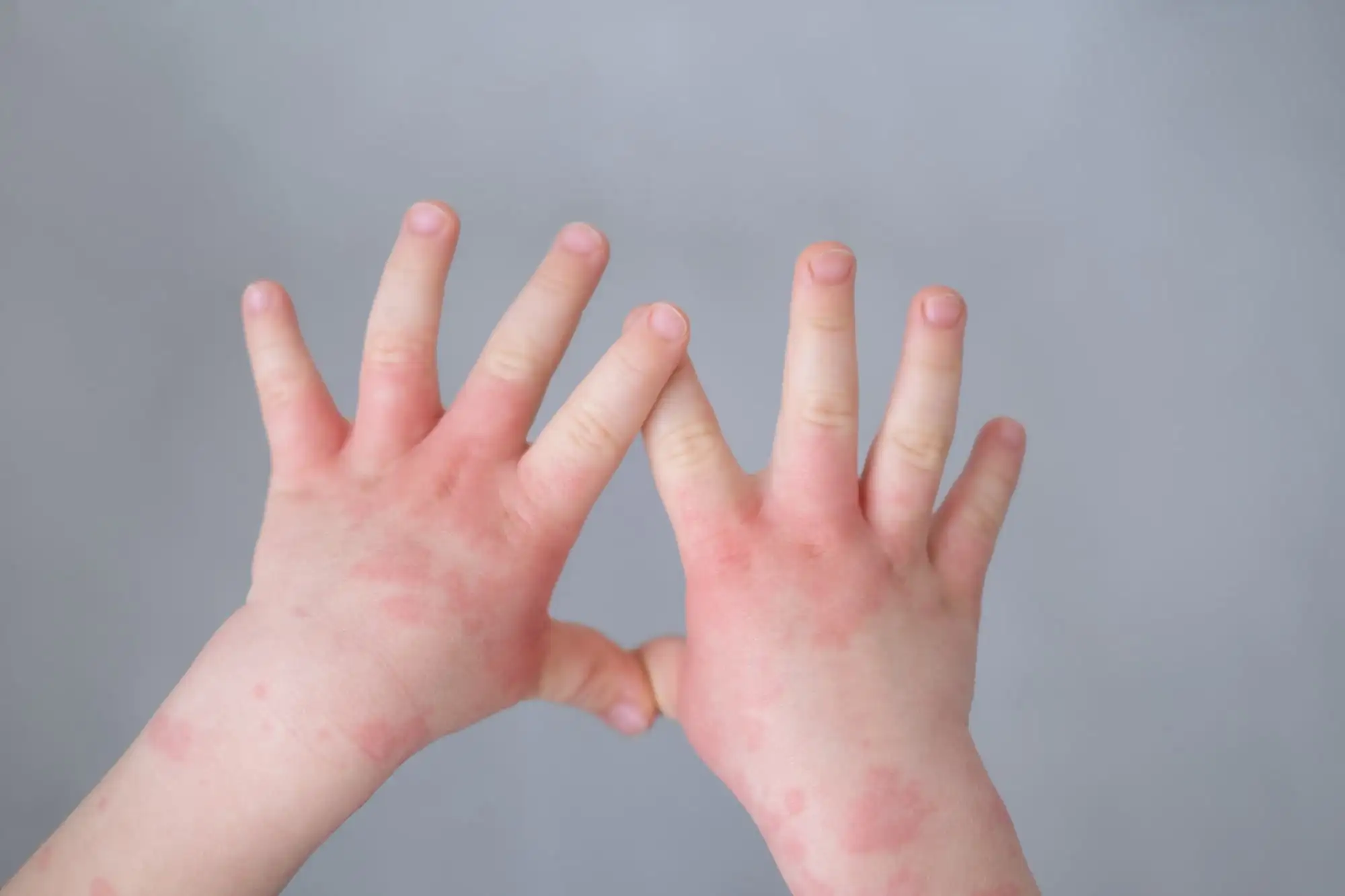 Pediatric atopic dermatitis