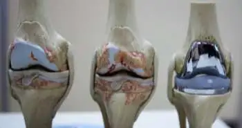 Протезирование коленного сустава как эффективный метод лечения дистрофии, вызванной болезнью Блаунта