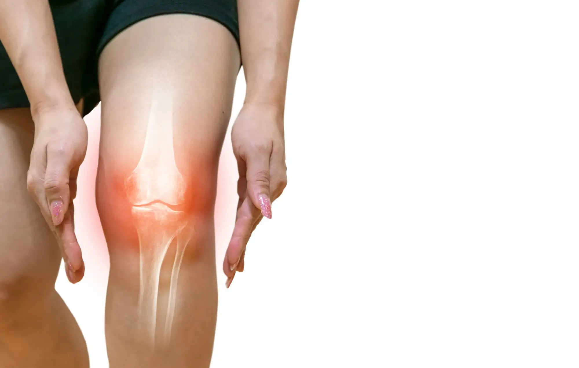 Knee osteoarthritis