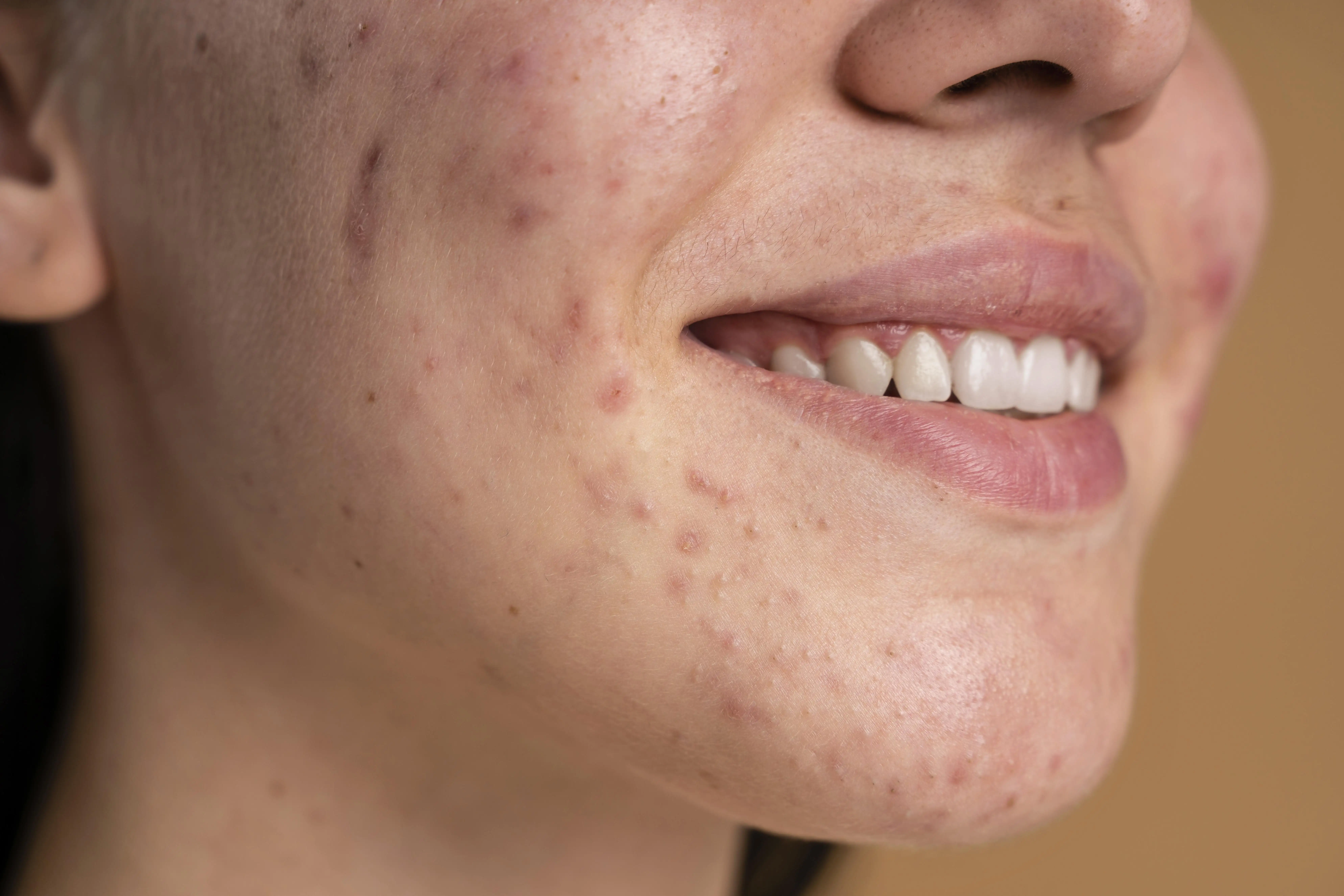 Acne vulgaris