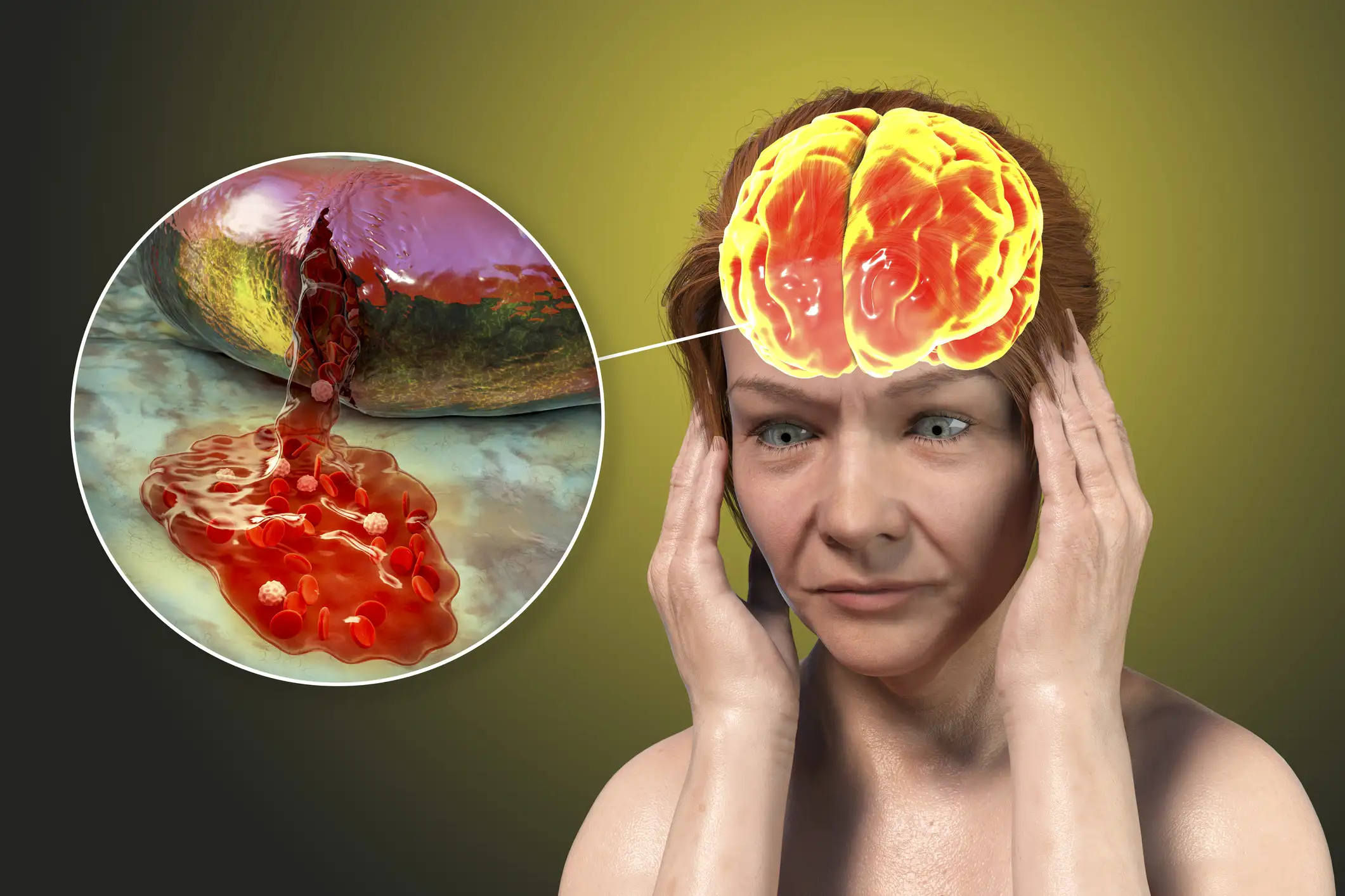 Апиксабан против ривароксабана: новые данные о геморрагическом риске из реальной практики