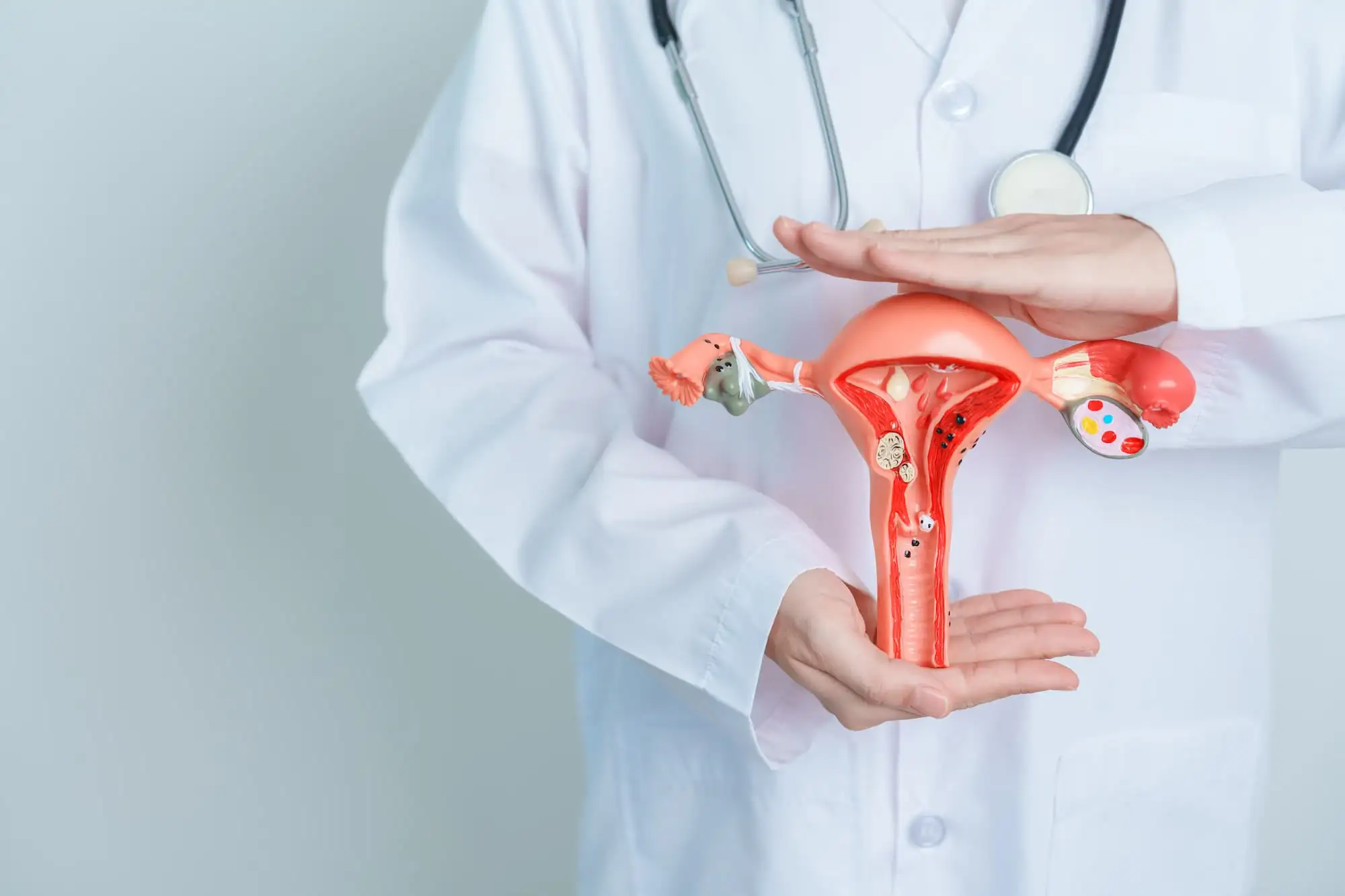 Polycystic ovary syndrome