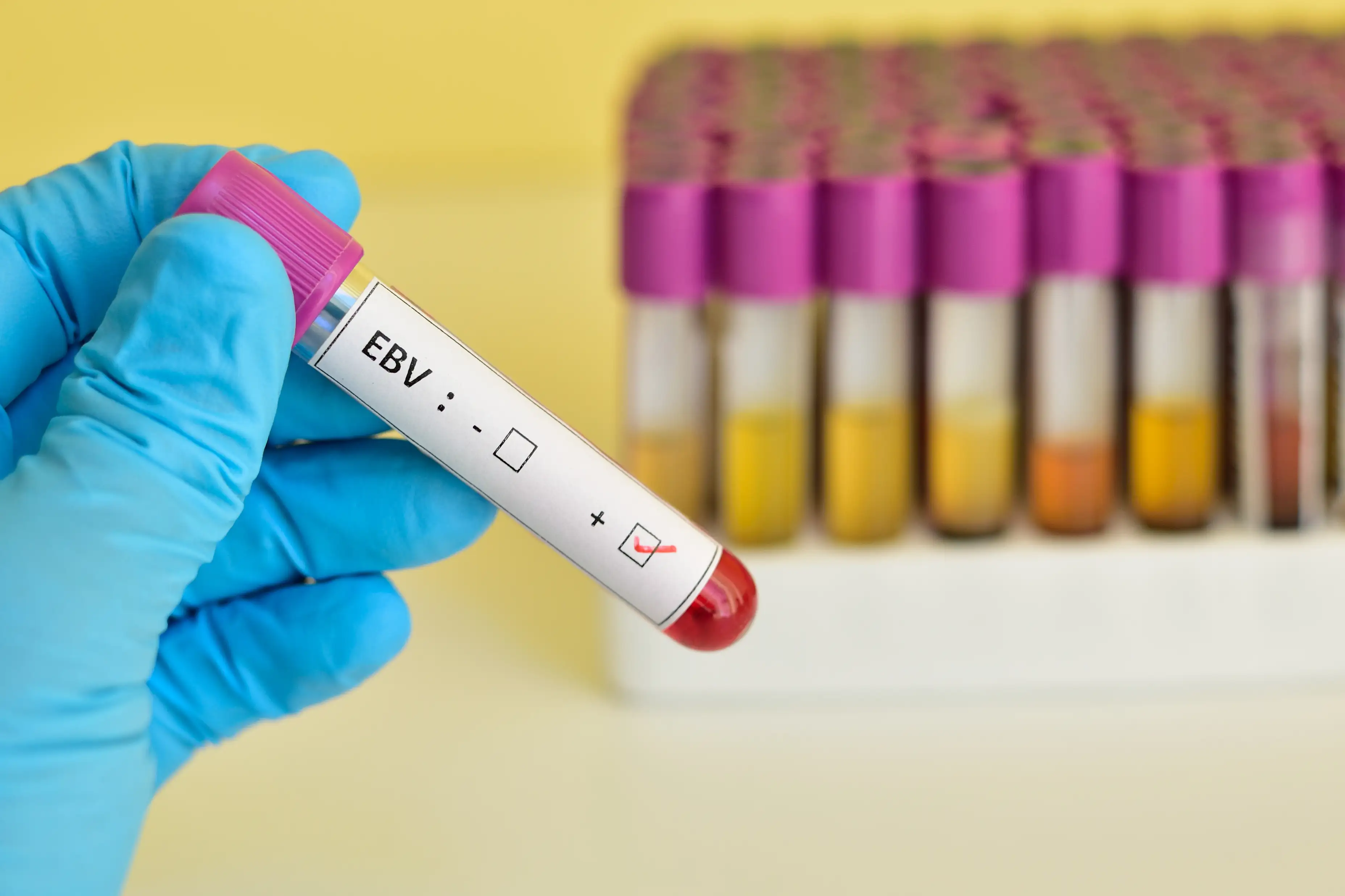 Вирус Эпштейна-Барр расшифровал пусковой механизм системной красной волчанки