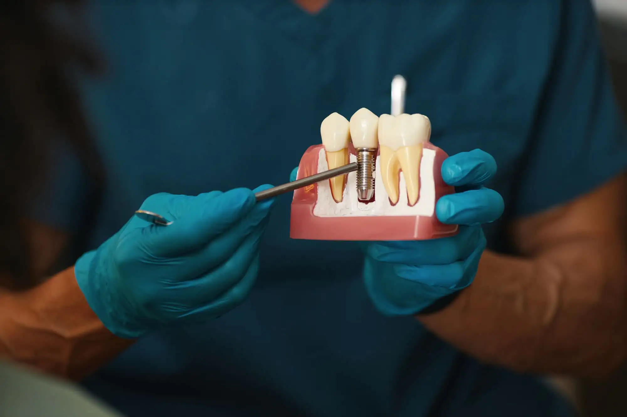 Dental implant placement