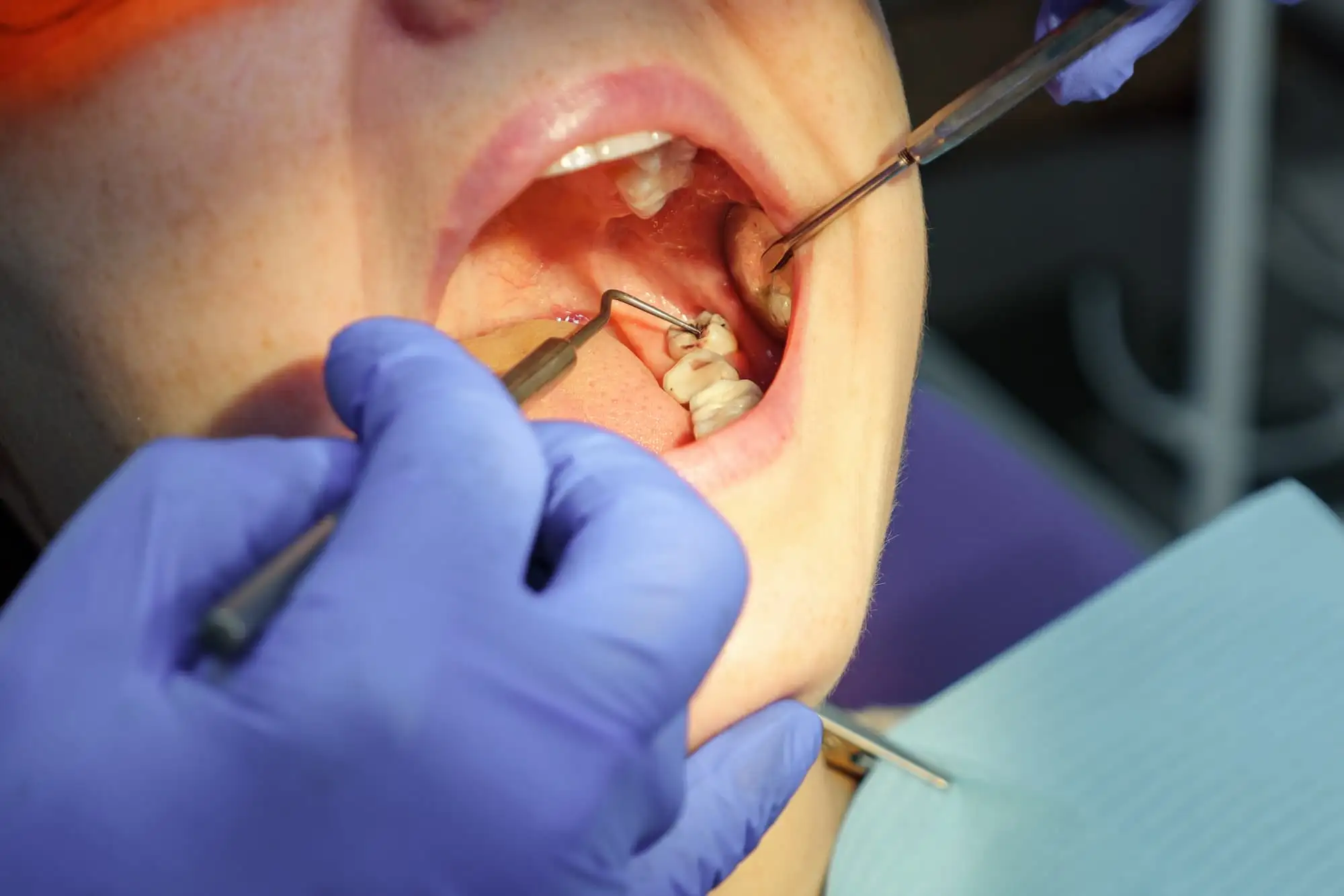 Third molar extraction