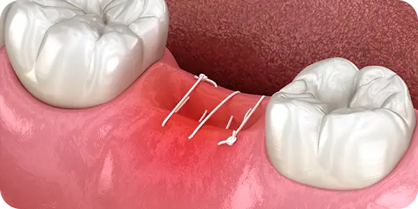 Мягкотканные отёки после удаления зуба: факторы, патогенез и подходы к терапии