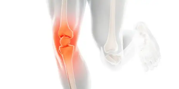 Хронический болевой синдром в коленном суставе без структурных изменений