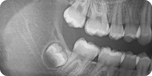 Послеоперационное обезболивание после удаления ретинированных зубов
