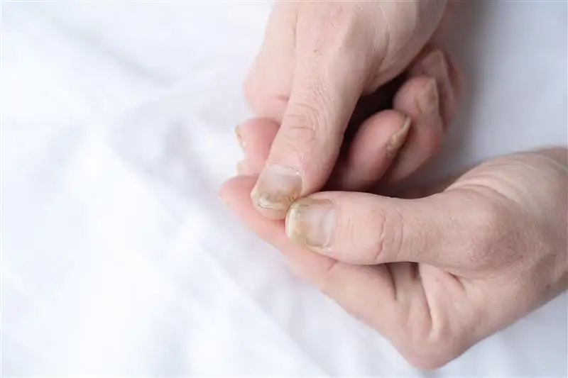 Onychomycosis