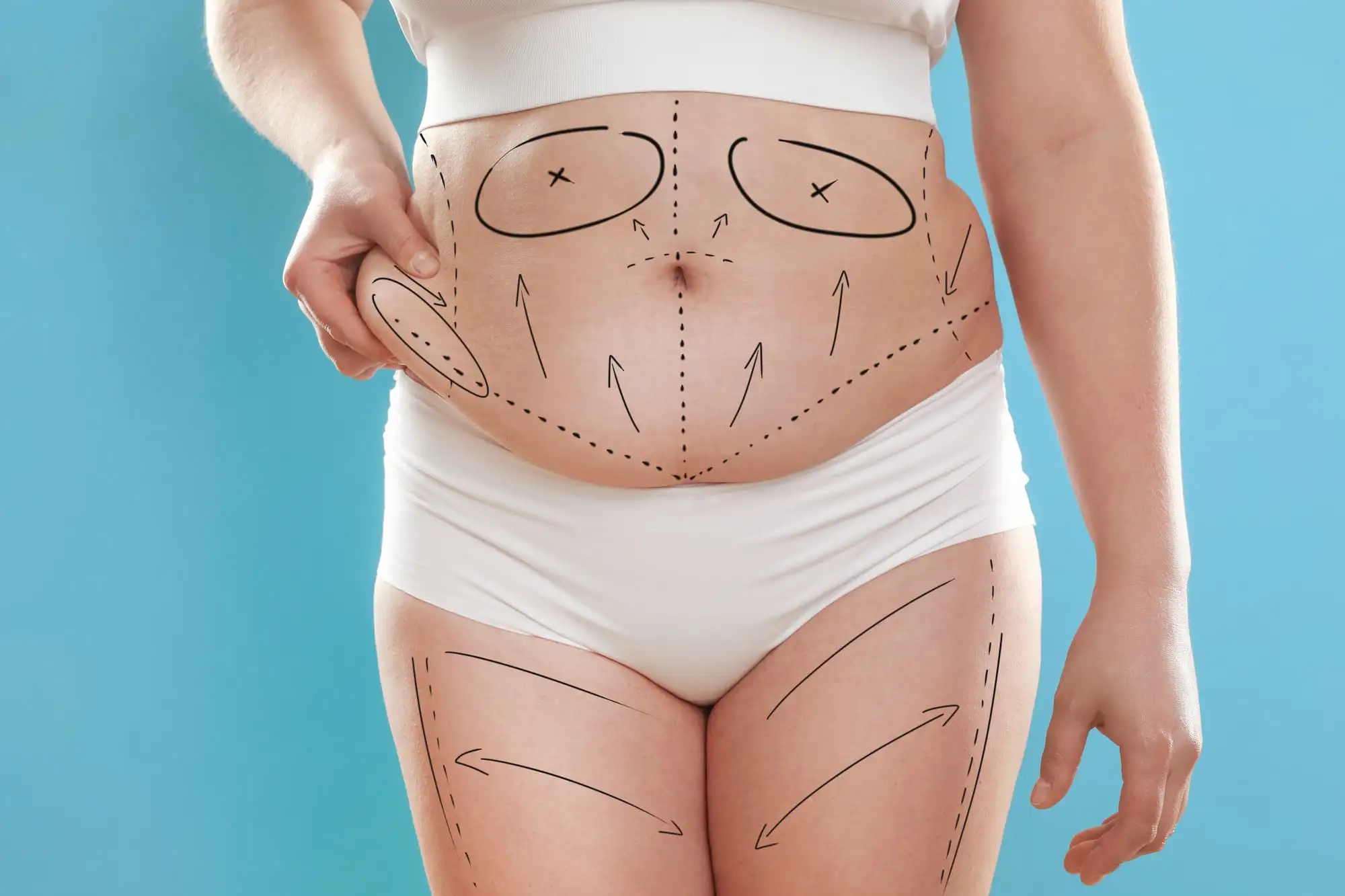 Weight loss surgery, GERD