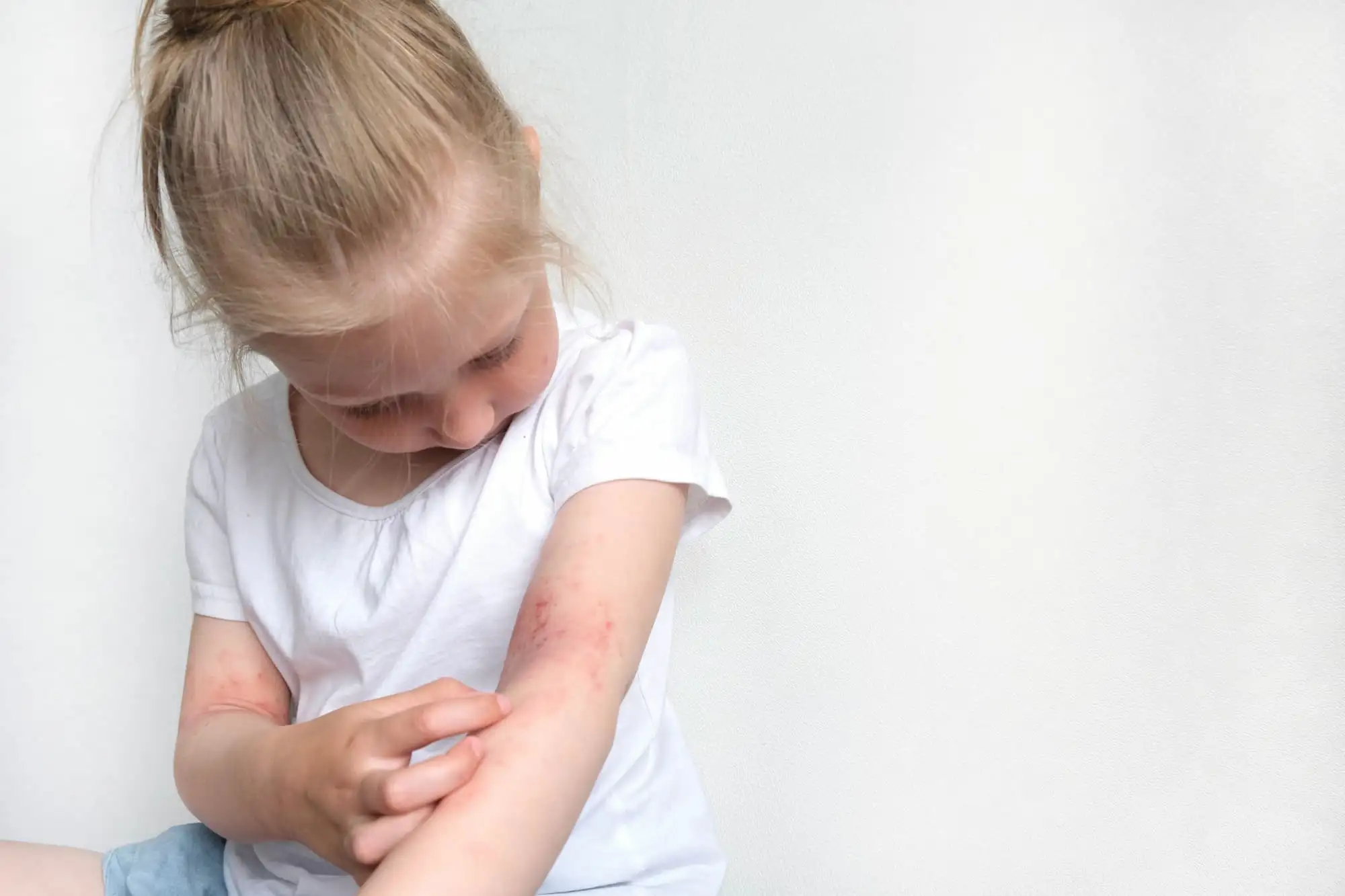 Atopic dermatitis in children