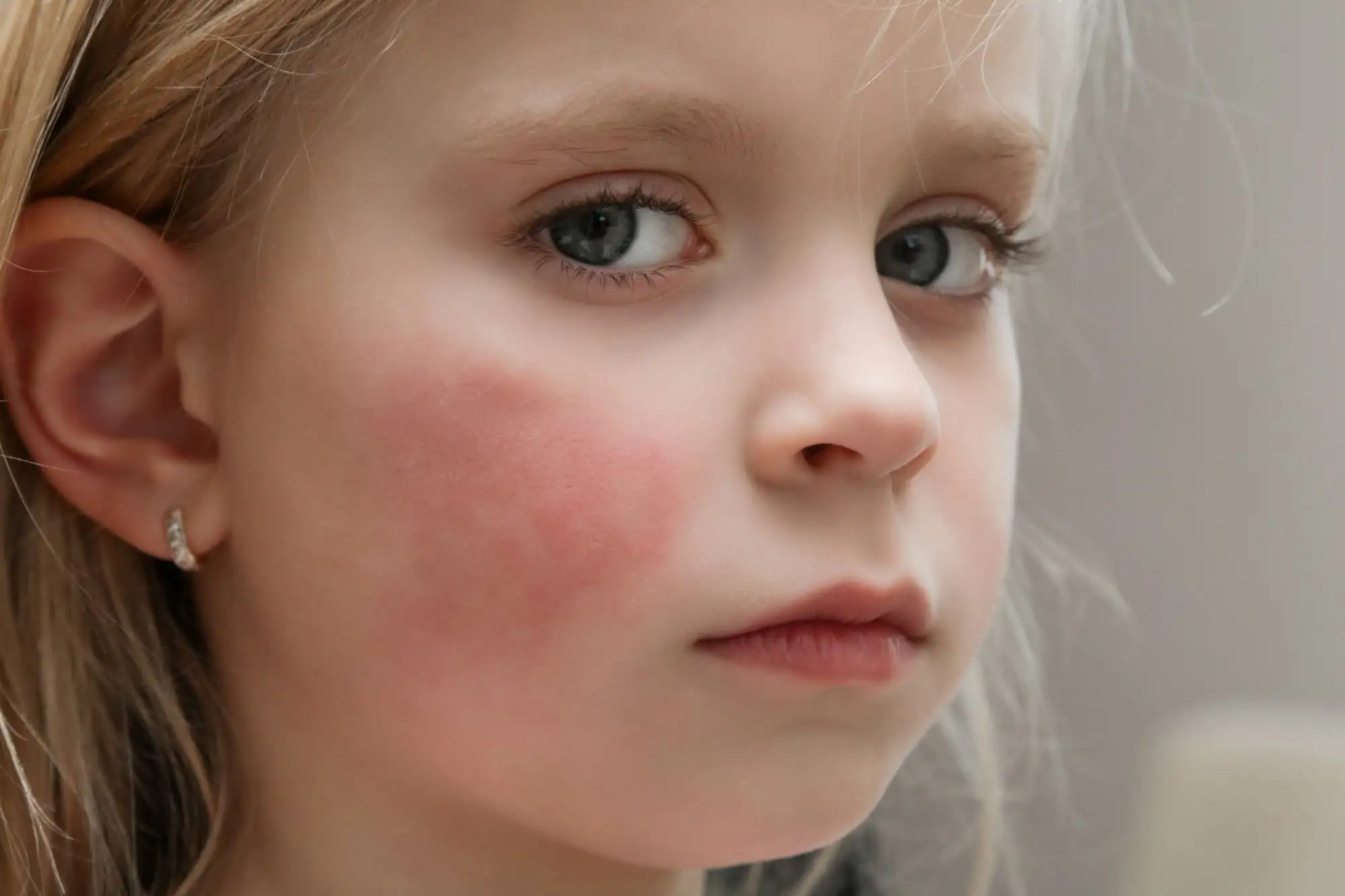Atopic dermatitis in children