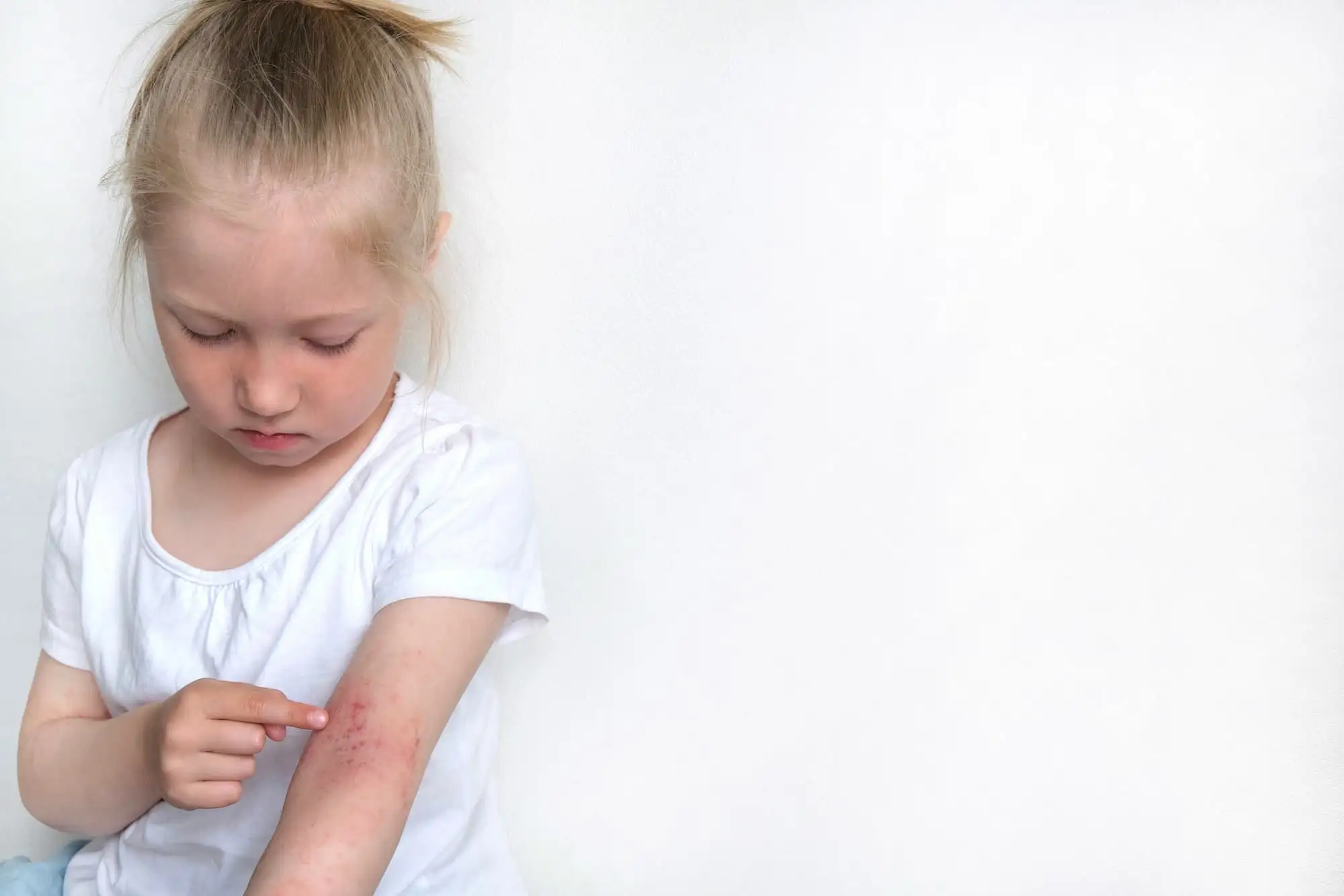 Atopic dermatitis in children