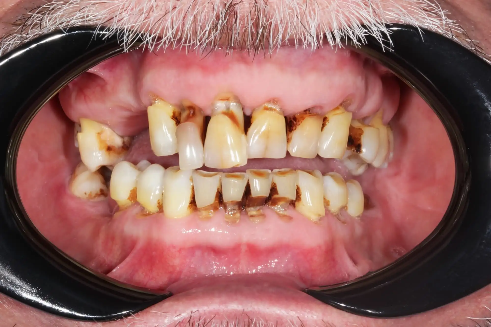 Chronic periodontitis