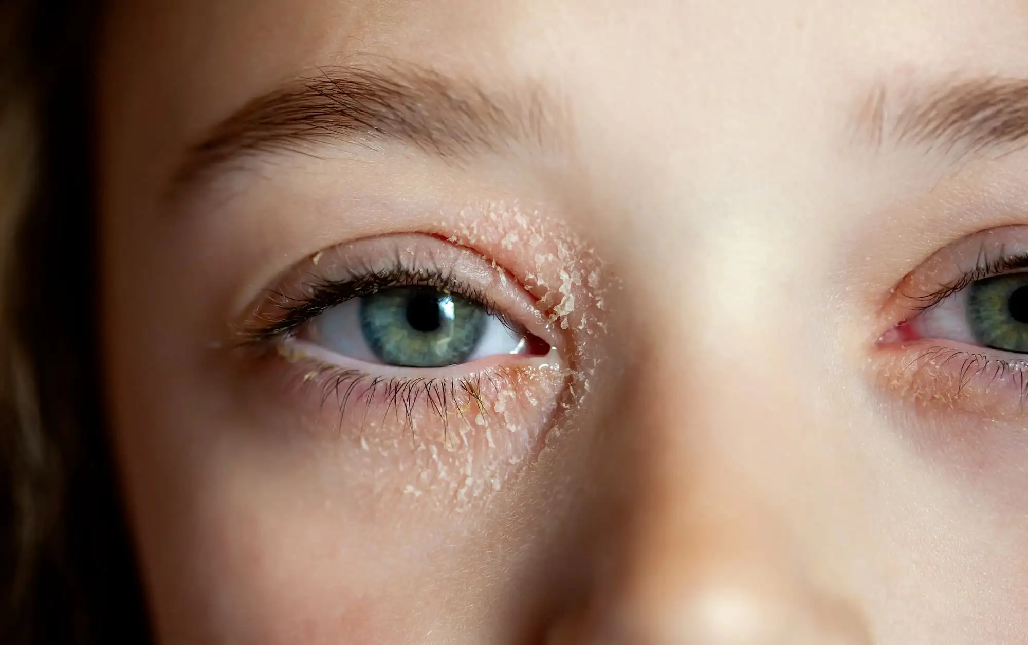 Atopic dermatitis in children