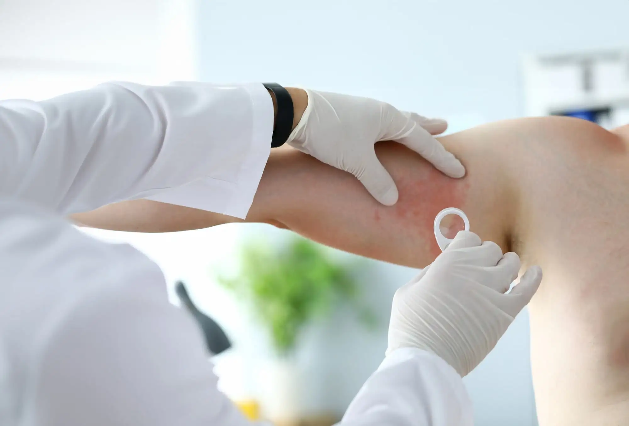 Chronic spontaneous urticaria