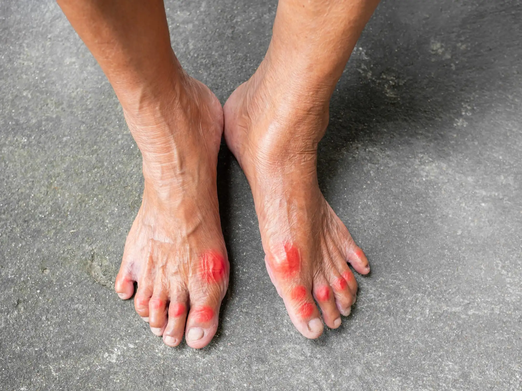 Gout