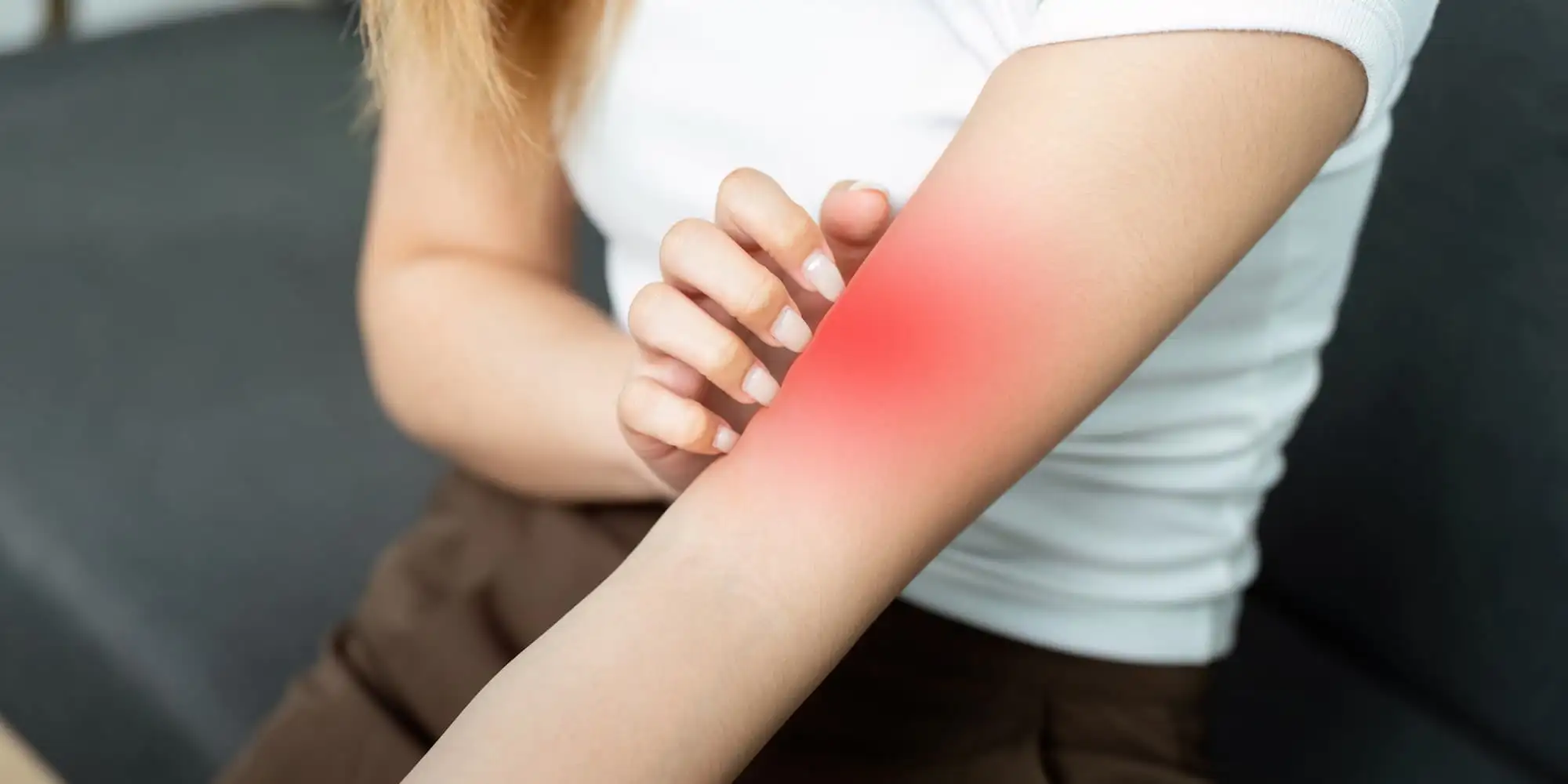 Red skin syndrome