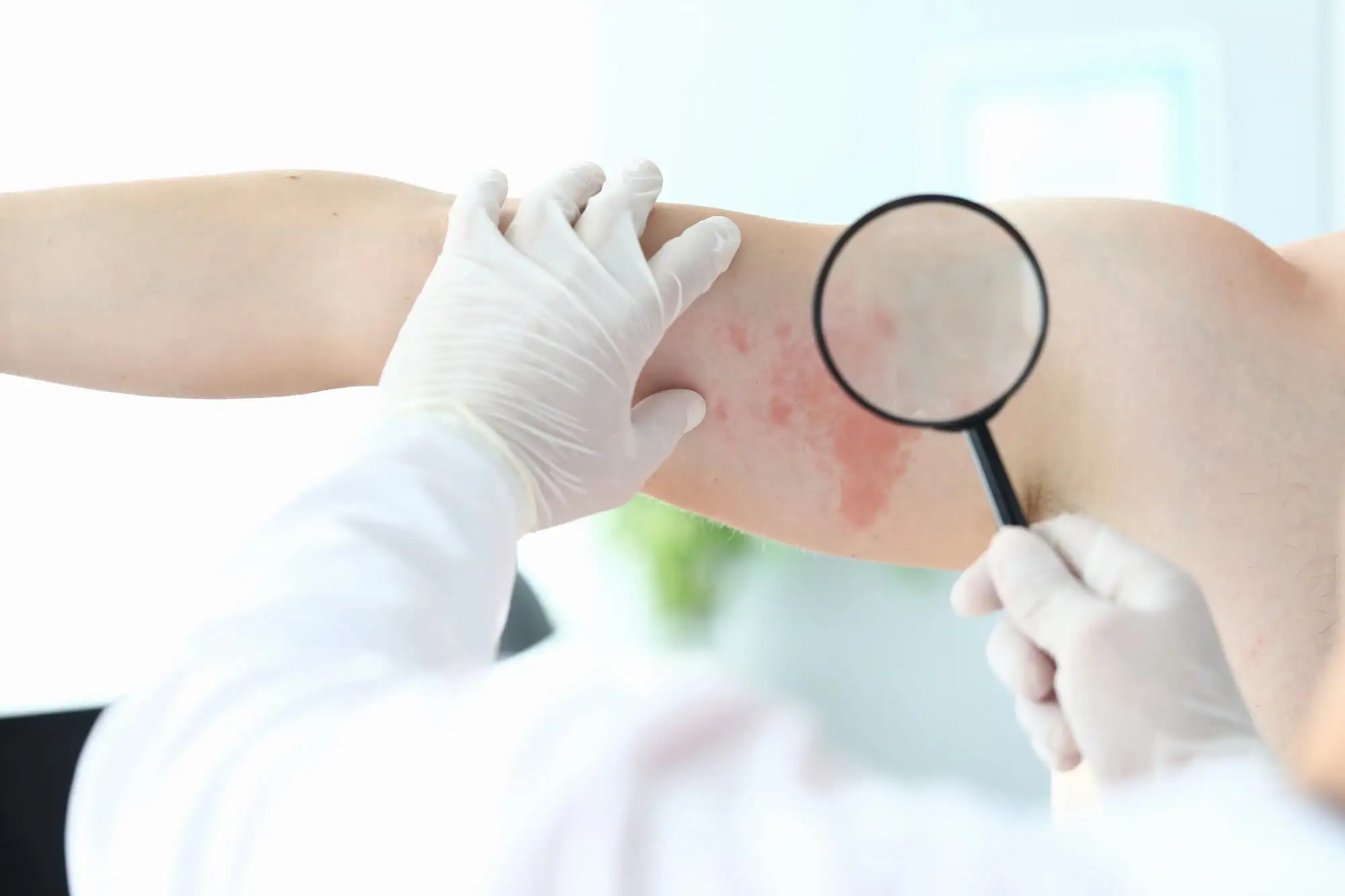 Chronic spontaneous urticaria