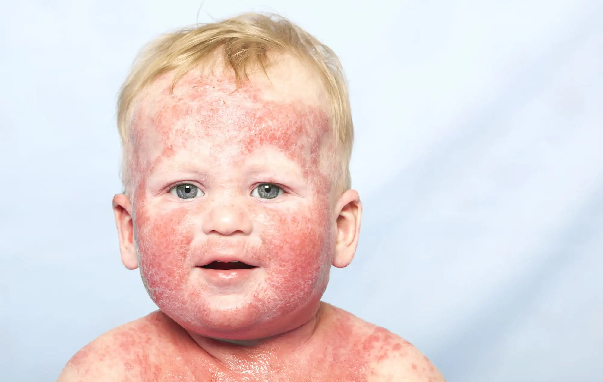 Allergic diseases in premature infants