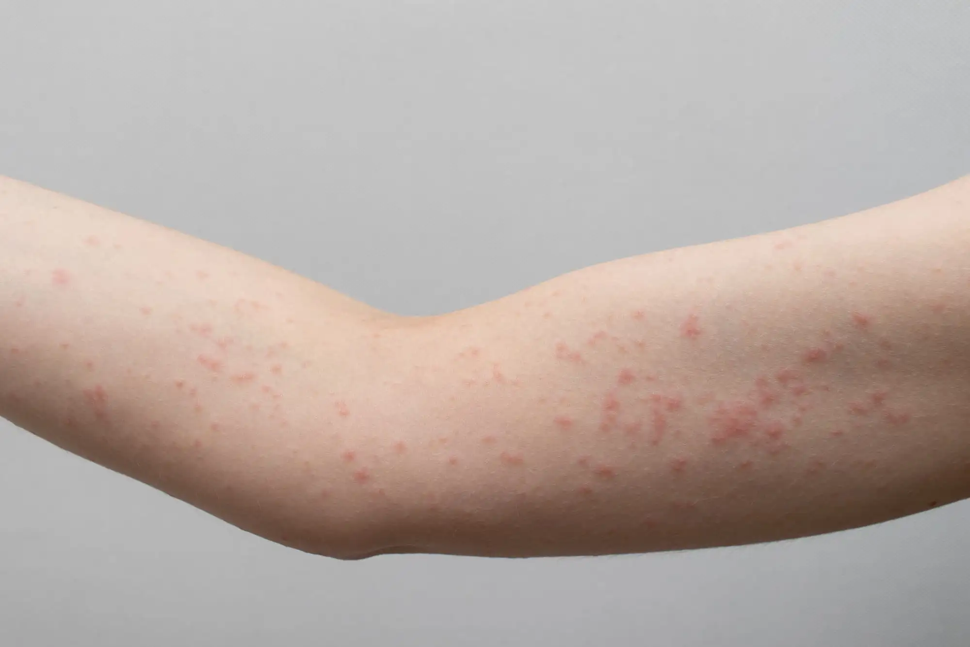 Chronic spontaneous urticaria