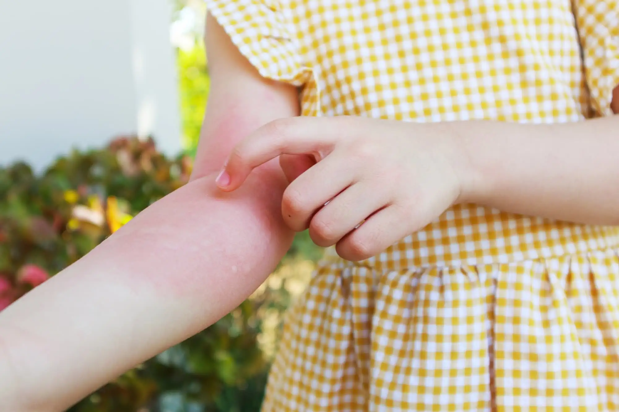 Chronic spontaneous urticaria in pediatrics and adults
