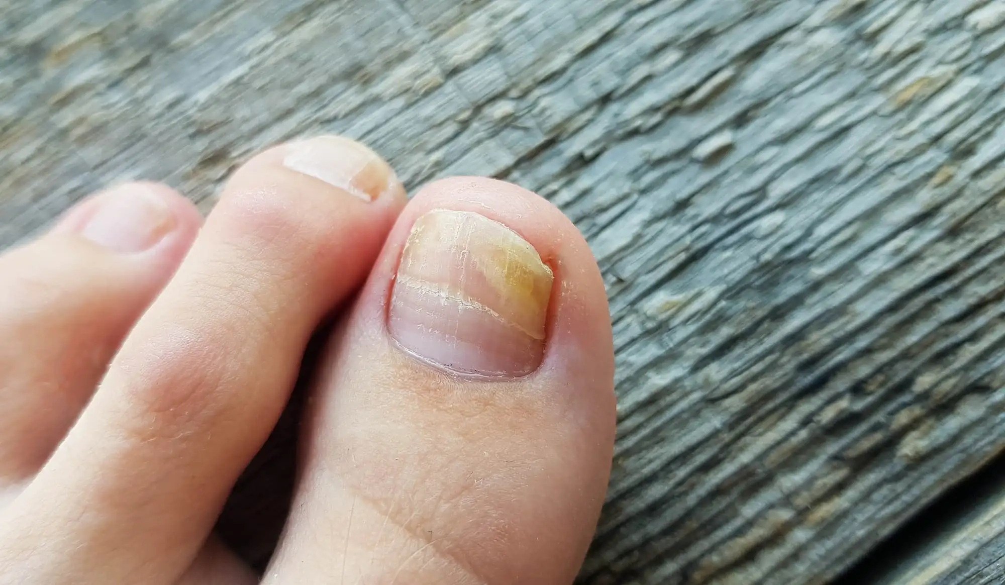 Onychomycosis