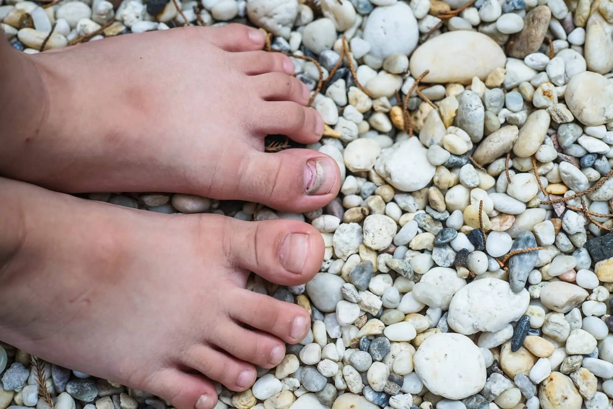 Green nail syndrome in pediatrics