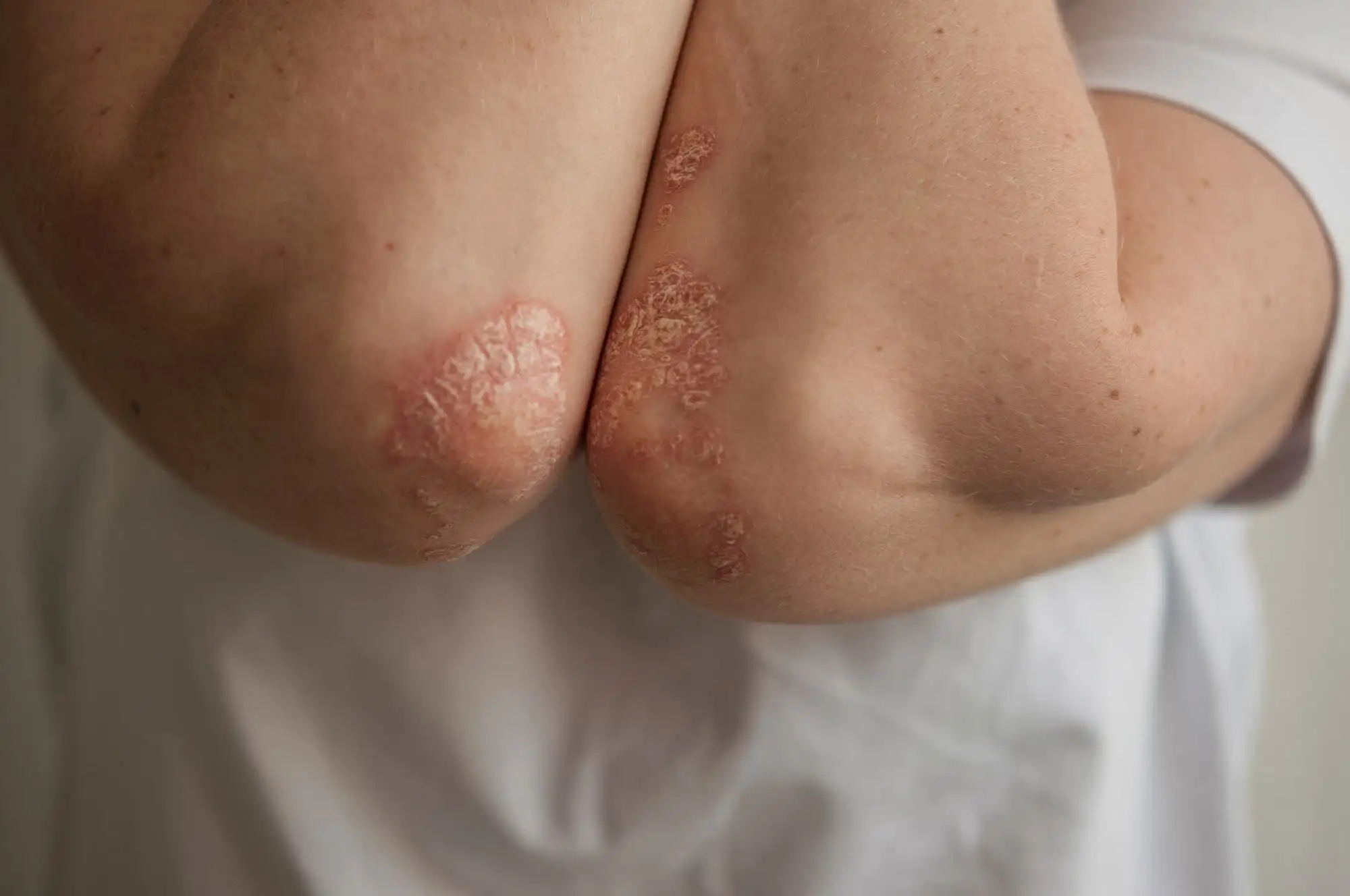 Psoriatic arthritis