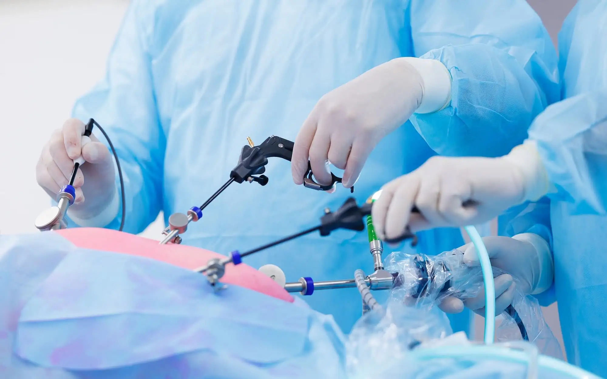Laparoscopic cholecystectomy