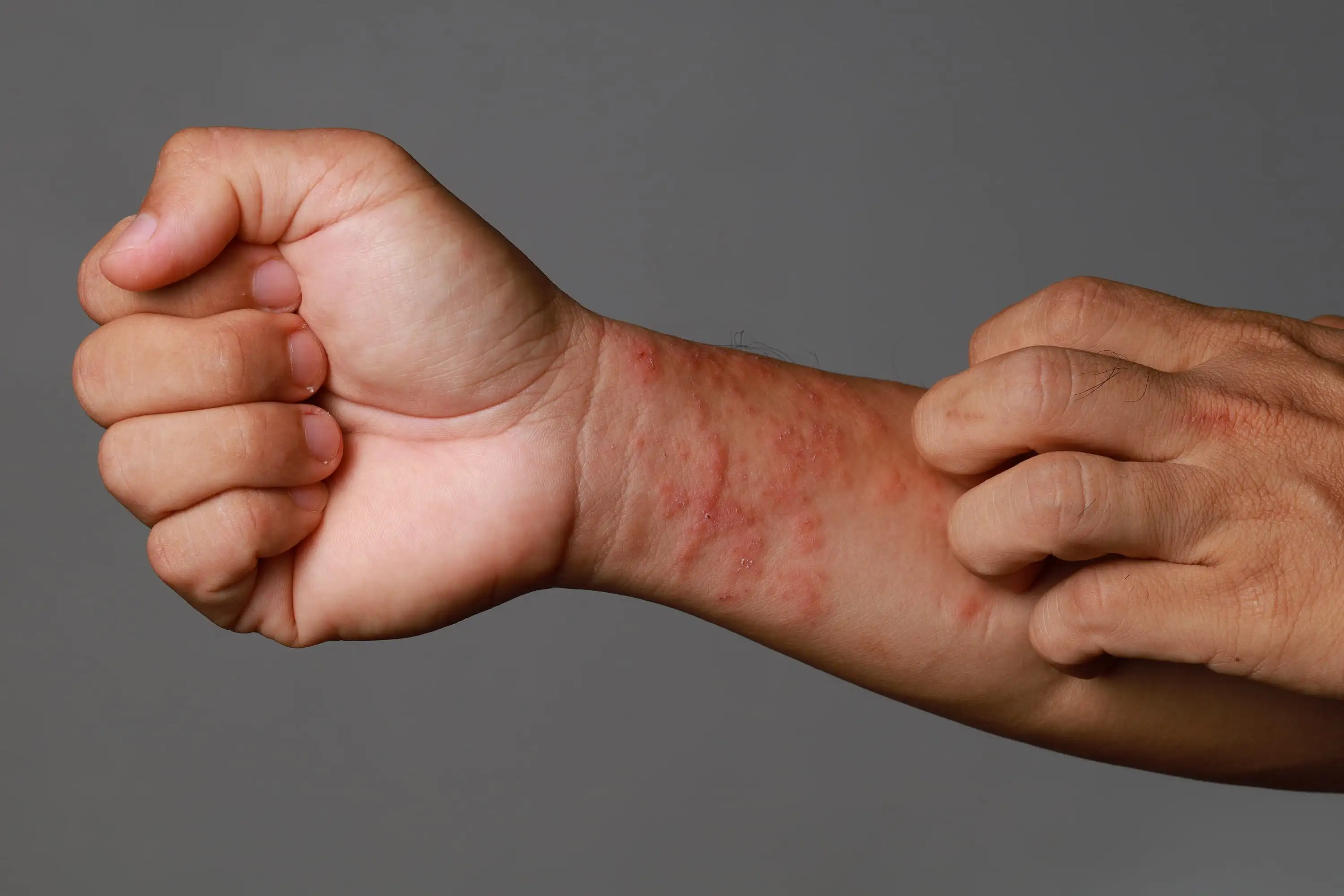 Atopic dermatitis