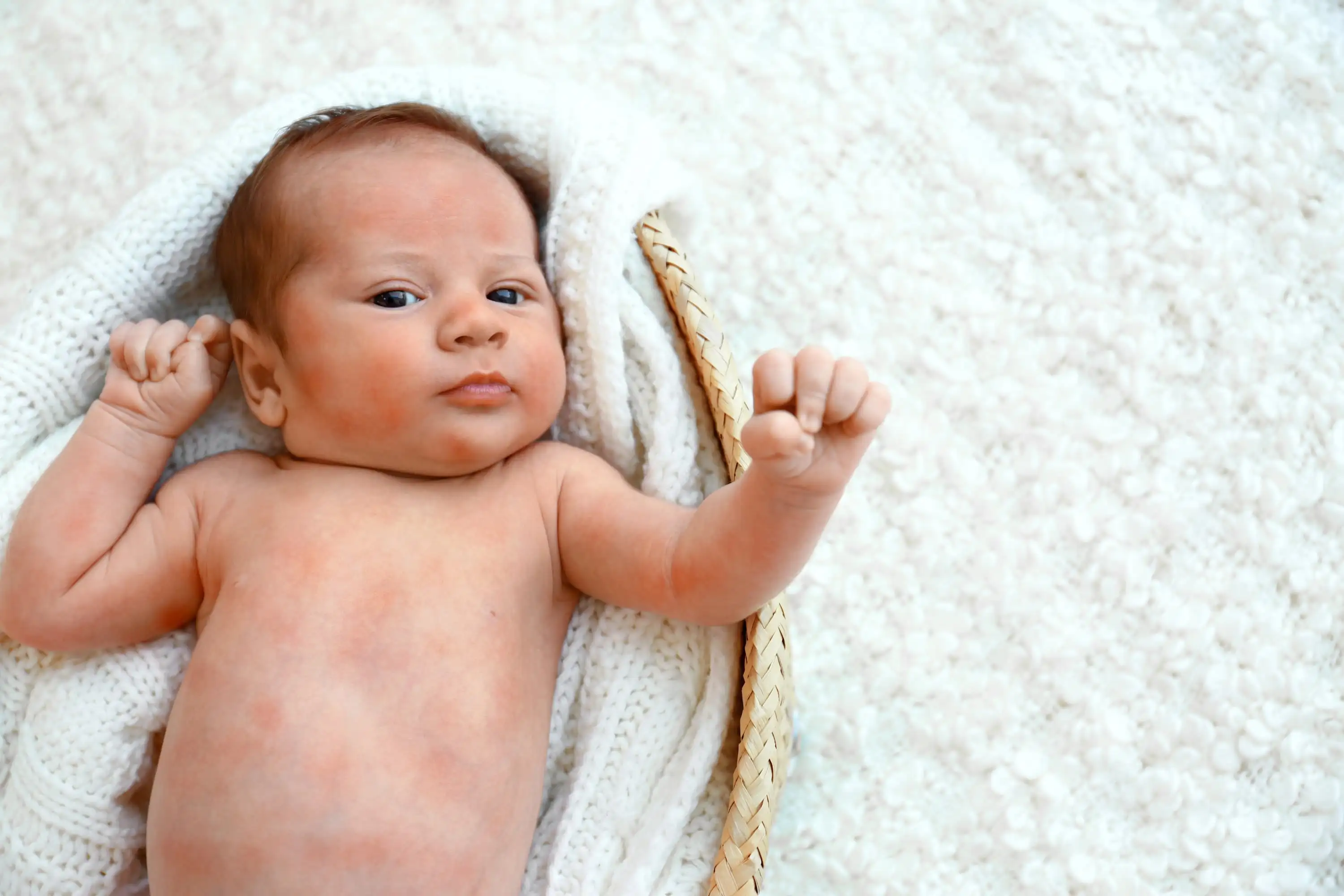 Eczema in children