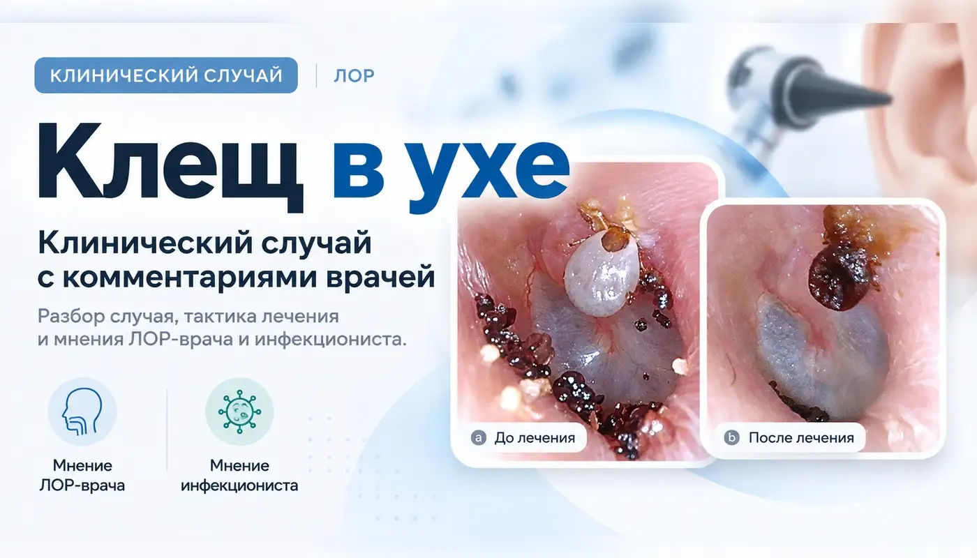 Клещ в ухе: клинический случай с комментариями врачей