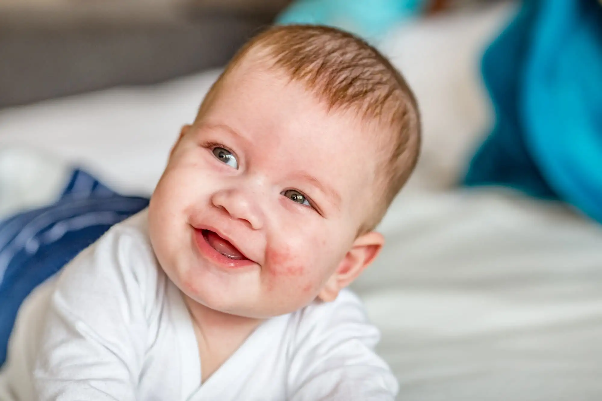 Atopic dermatitis in children