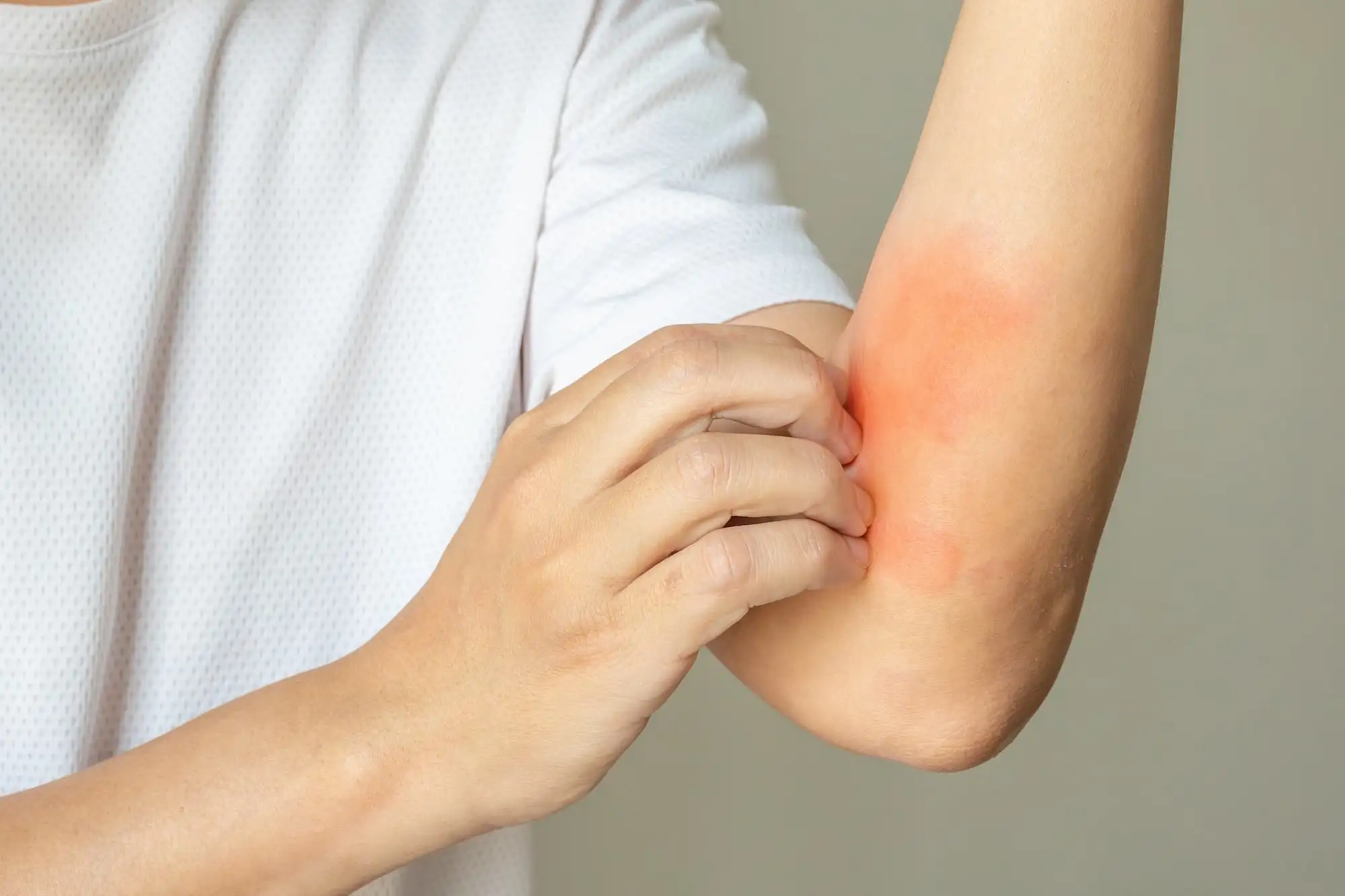 Atopic dermatitis