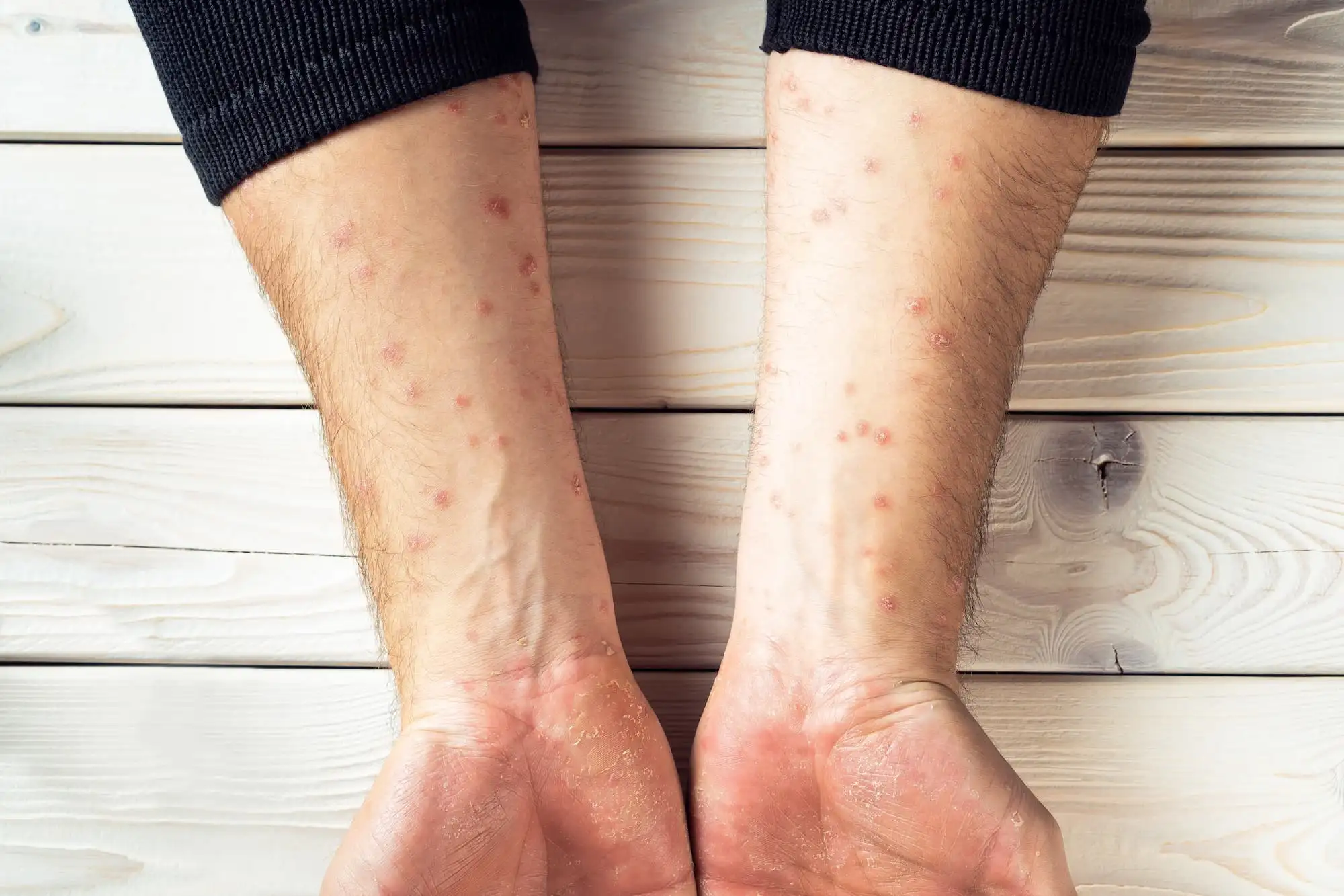 Plaque psoriasis
