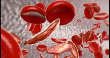 Установлена связь между острой вазоокклюзионной болью и началом менструации у женщин с серповидно-клеточной анемией
