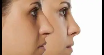 Средства, уменьшающие отек слизистых оболочек носа, оказывают благоприятный эффект на состояние пациентов, прошедших в недавнем времени септопластику