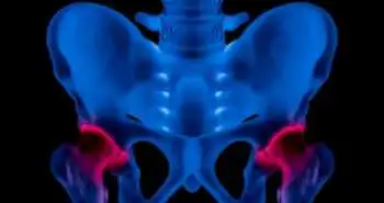 Систематичний огляд і метааналіз досліджень з оцінки ефективності внутрішньосуглобових ін'єкцій стероїдів для лікування остеоартрозу кульшового суглоба