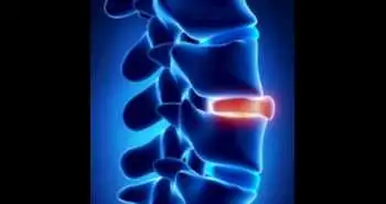 Effectiveness of IL-17 inhibitors for ankylosing spondylitis treatment